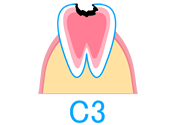 「C3」神経まで達したむし歯