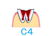 「C4」歯の根まで進行したむし歯