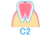 「C2」歯の中（象牙質）のむし歯