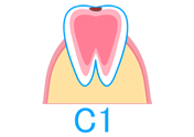 「C1」歯の表面（エナメル質）のむし歯